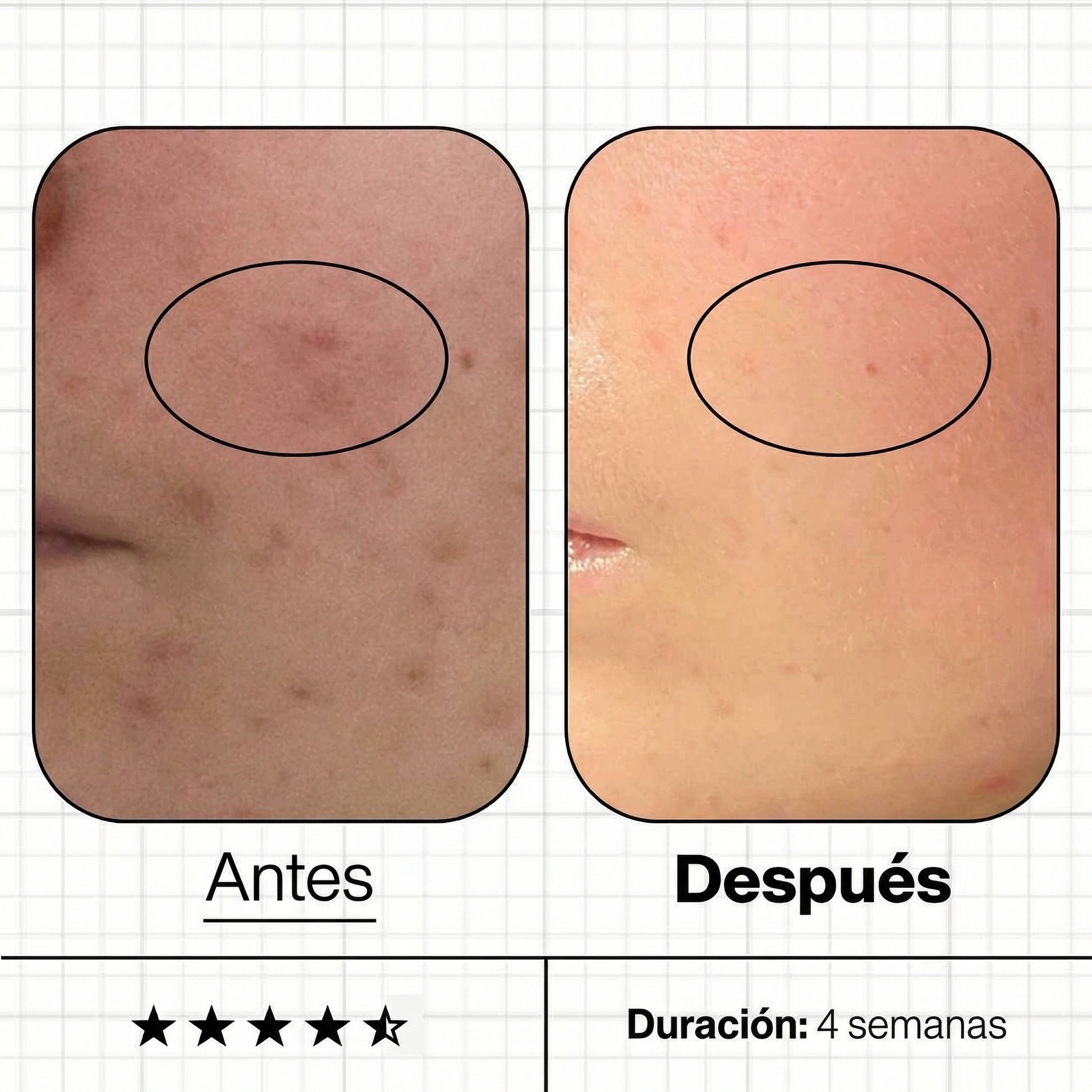 Imágenes de "antes y después" tras el uso de Clear Skin Biome, donde se aprecia la reducción de imperfecciones, el control del exceso de grasa y una piel más calmada y equilibrada.
