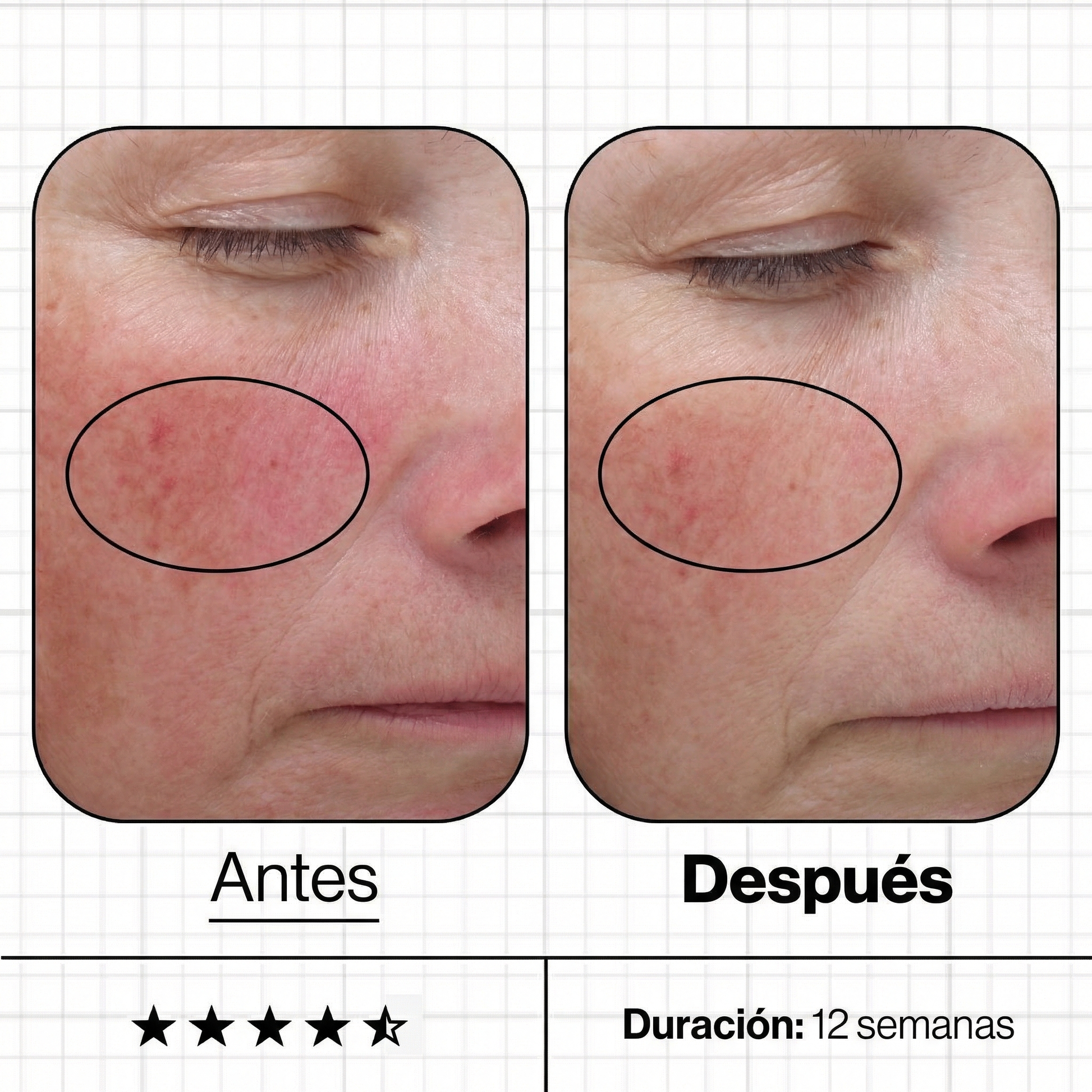 Comparativa de "antes y después" que muestra la reducción visible de manchas y una mejora en la uniformidad del tono de la piel tras usar Skin Even IQ